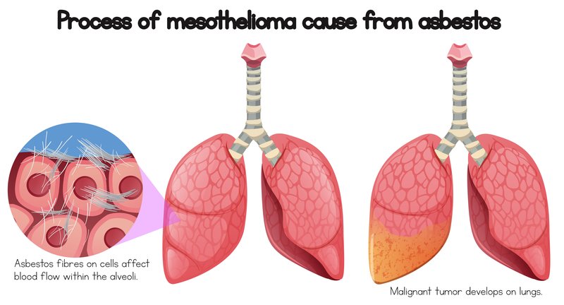Process of Mesothelioma